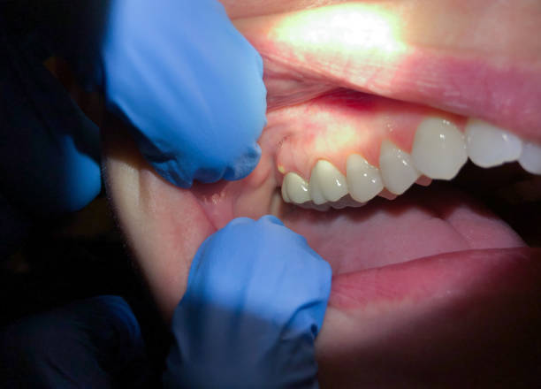 Best Emergency Denture Repair in Hazel Crest, IL